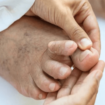 HAMMERTOE TREATMENT